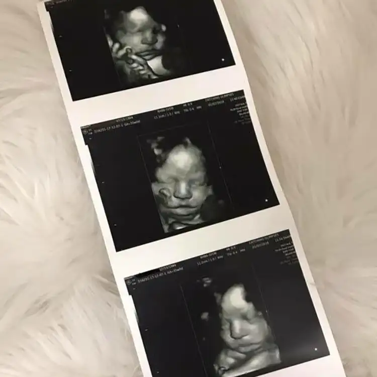 Catching Glimpses - 3 black and white photos of 3D ultrasound, baby's clear face - Effingham, IL