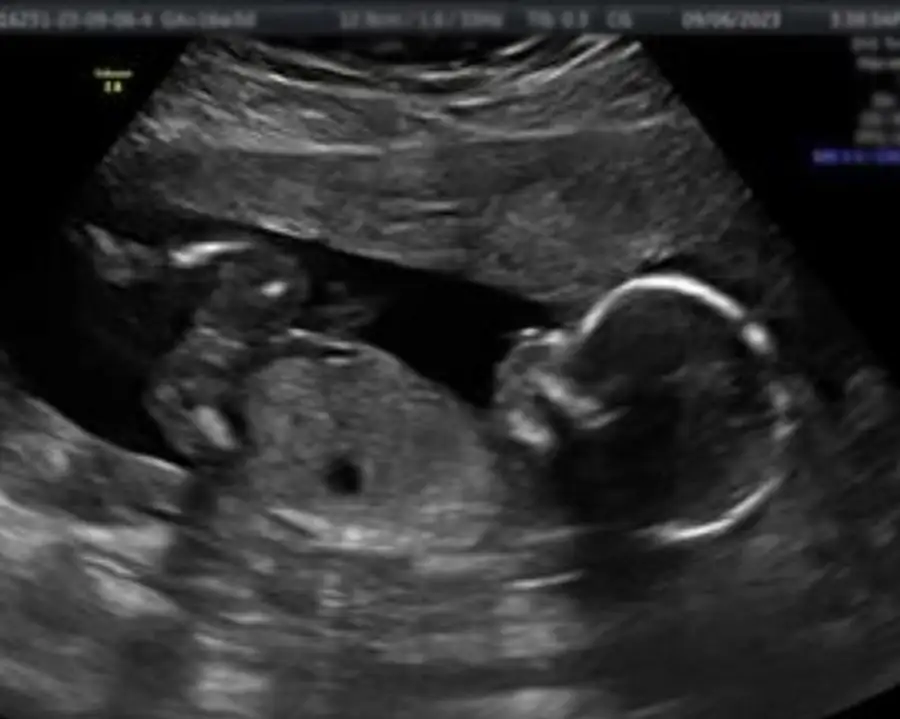 Catching Glimpses 4D Ultrasound - 2D ultrasound image, baby silhouette clear - Centralia, IL